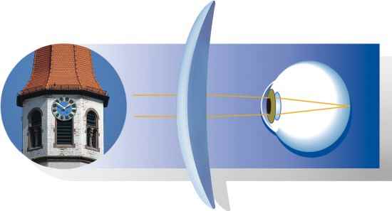 Hyperopes Auge mit korrigierendem Plusglas