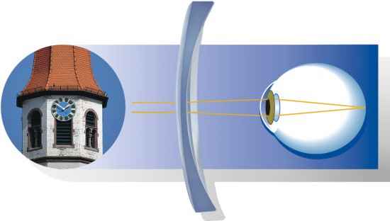 Myopes Auge mit korrigierendem Minusglas